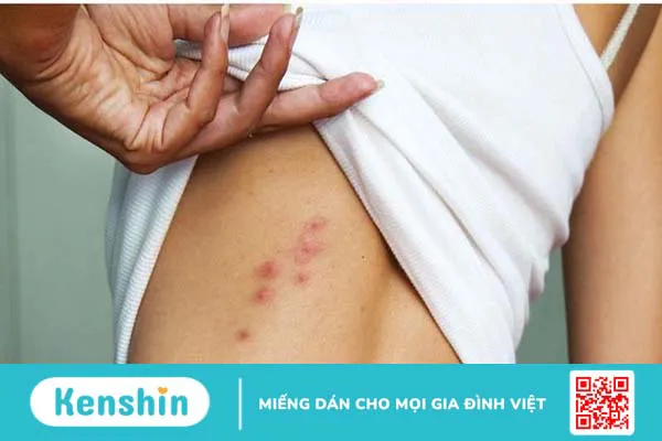 Chữa vảy nến bằng nhựa đu đủ có hiệu quả không?