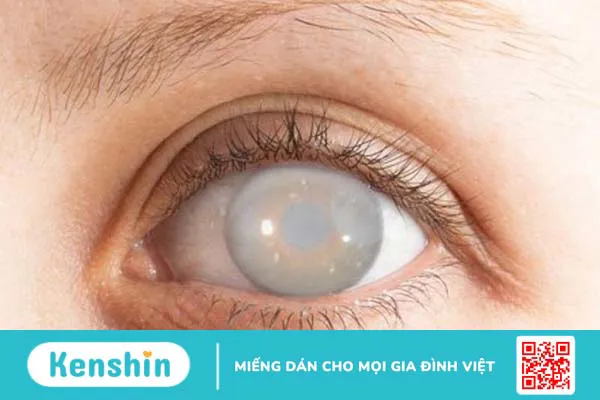 Chứng mù bẩm sinh Leber: Triệu chứng, nguyên nhân, biện pháp chẩn đoán và điều trị 1