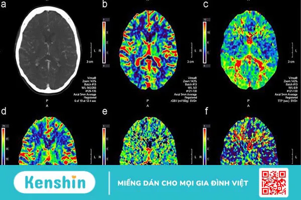 Chụp cắt lớp vi tính tưới máu não và một số thông tin hữu ích 1