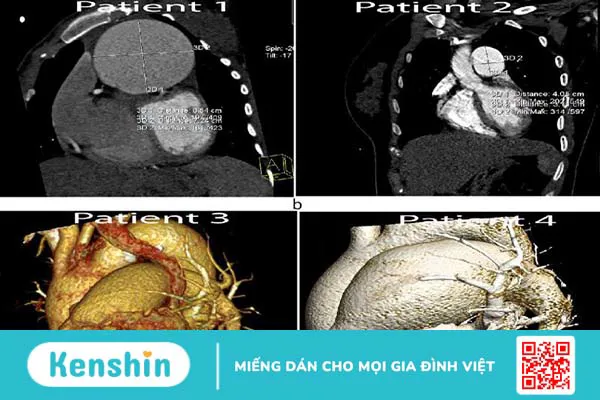 Chụp CT 128 dãy: Ứng dụng, ưu nhược điểm và một số lưu ý