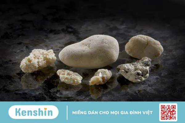 Chụp CT sỏi thận giúp chẩn đoán bệnh gì? Đối tượng nào cần đi chụp CT sỏi thận?