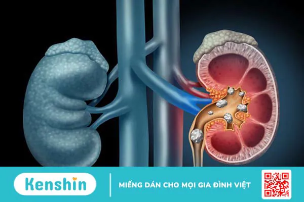 Chụp CT sỏi thận giúp chẩn đoán bệnh gì? Đối tượng nào cần đi chụp CT sỏi thận?