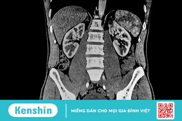 Chụp CT thận ứ nước là gì? Khi nào cần thực hiện?