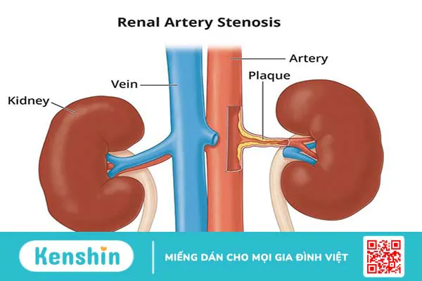 Chụp động mạch thận có thể chẩn đoán những bệnh nào?