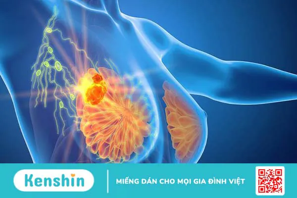 chụp nhũ ảnh - phương pháp tầm soát và chẩn đoán ung thư vú 2