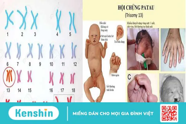 Chuyển đoạn Robertson có thể gây ra những hậu quả gì?