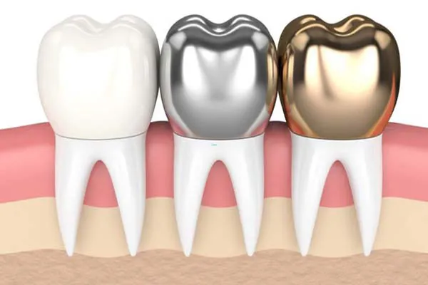 Có nên bọc mão răng sứ không? Cách chăm sóc răng sứ sau khi bọc