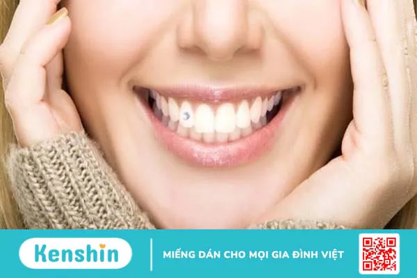 Có nên đính đá răng thẩm mỹ hay không?