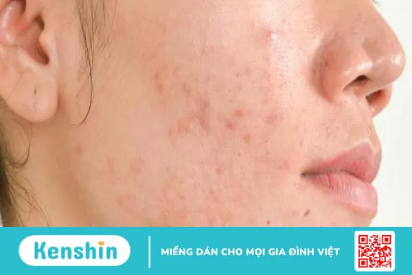 Có nên kết hợp ceramide và niacinamide trong chăm sóc da?