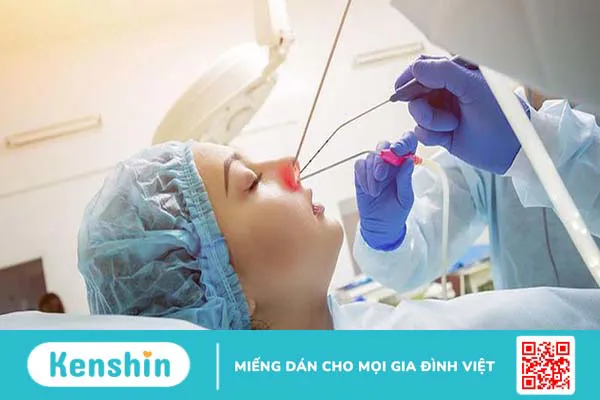 Có nên mổ viêm xoang không? Các phương pháp và lưu ý khi phẫu thuật 3