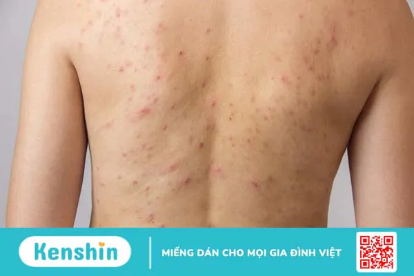 Công dụng và cách dùng sữa tắm giảm mụn lưng Neo Acnes tinh chất tràm trà