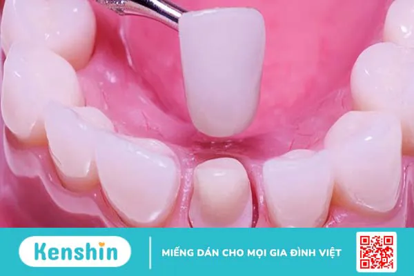 Cùi răng sứ giả là gì? Lợi ích của việc làm cùi răng sứ giả