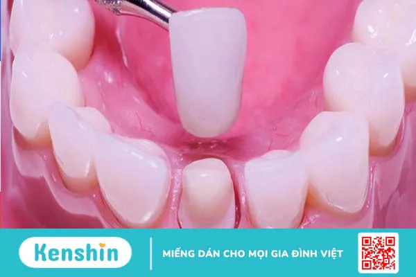 Cùi răng sứ giả là gì? Lợi ích của việc làm cùi răng sứ giả