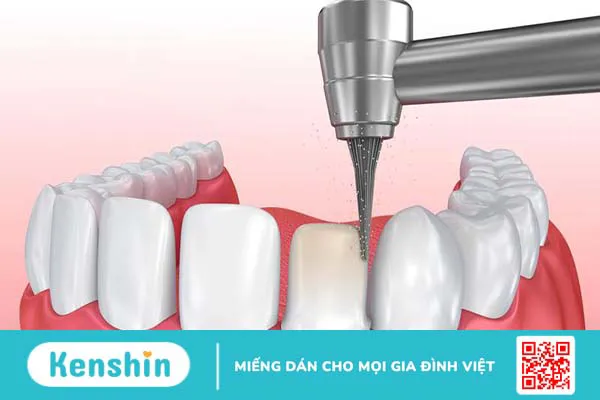 Cùi răng sứ giả là gì? Lợi ích của việc làm cùi răng sứ giả