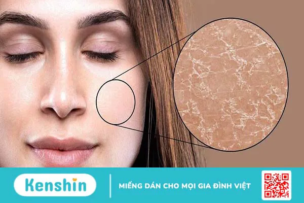 Da bị khô từng mảng: Nguyên nhân và giải pháp