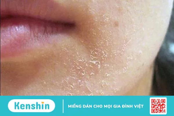 Da bị khô từng mảng: Nguyên nhân và giải pháp 1