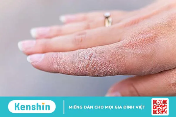 Da bị khô từng mảng: Nguyên nhân và giải pháp 4