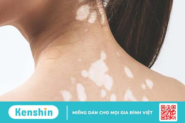 Da bị mất sắc tố phải làm sao?