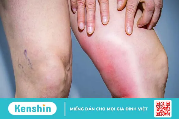 Da đau rát như bị bỏng là hiện tượng gì? Có nguy hiểm không?