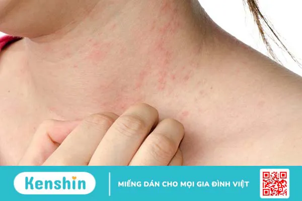 Da đau rát như bị bỏng là hiện tượng gì? Có nguy hiểm không?