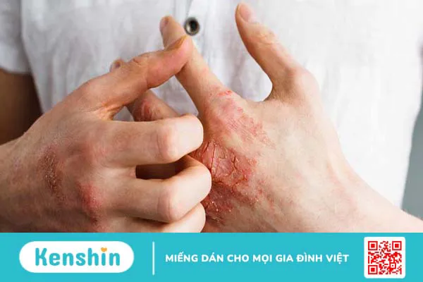 Da đau rát như bị bỏng là hiện tượng gì? Có nguy hiểm không?