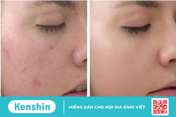 Da khô có nên peel da không? Một số lưu ý khi peel da