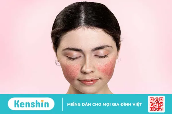 Da mặt bị đỏ – Dấu hiệu của hội chứng Rosacea