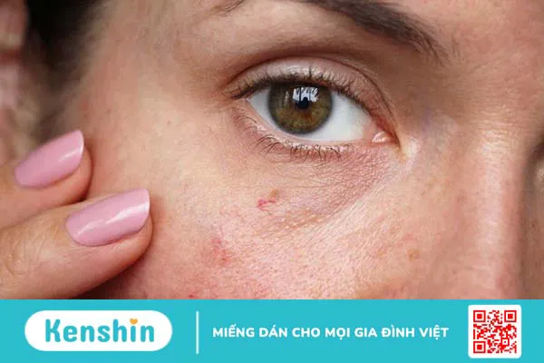 Da mặt bị đỏ và nóng do nguyên nhân gì? Có nguy hiểm đến sức khỏe không? 2