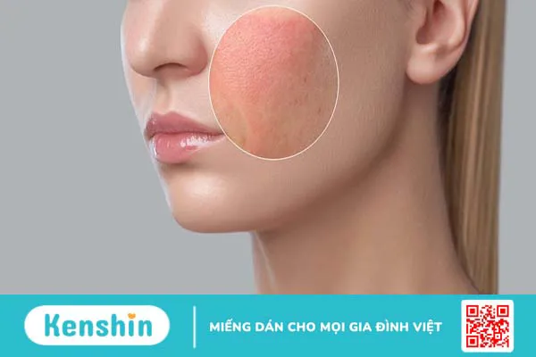 Da mặt bị ngứa châm chích có nguy hiểm không? Cách xử lý thế nào?