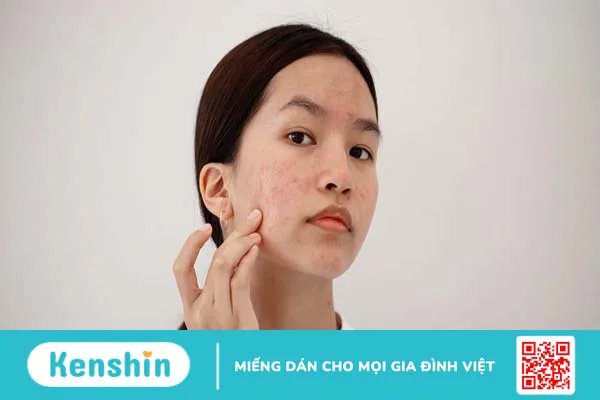 Da mặt bị ngứa sần sùi phải làm sao?