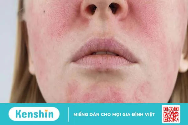 Da mặt nóng bừng và hồng đỏ cảnh báo bệnh lý gì?