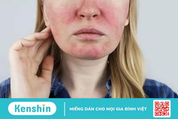 Da mặt nóng bừng và hồng đỏ cảnh báo bệnh lý gì 2