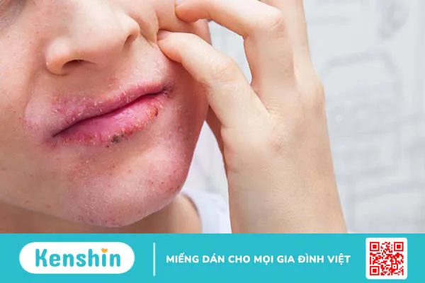 Da mặt nóng bừng và hồng đỏ cảnh báo bệnh lý gì 3