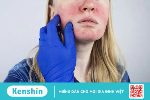 Da mặt nóng bừng và hồng đỏ cảnh báo bệnh lý gì 4