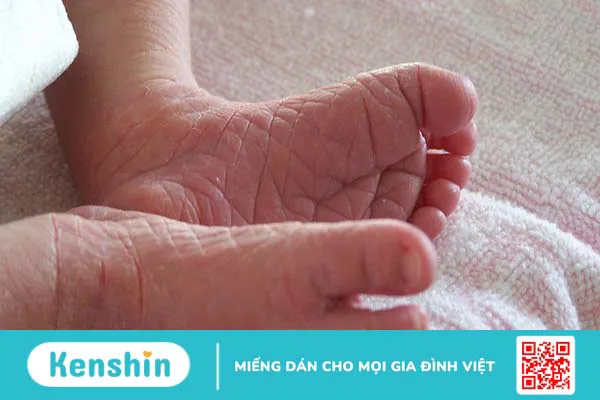 Da vảy cá ở trẻ sơ sinh: Nguyên nhân, triệu chứng, chẩn đoán và điều trị