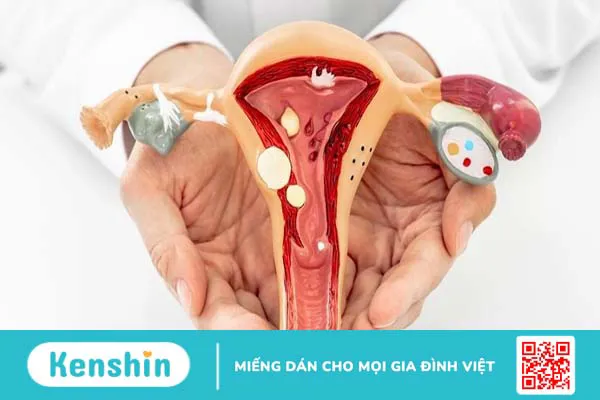 Đặc điểm hình ảnh polyp cổ tử cung