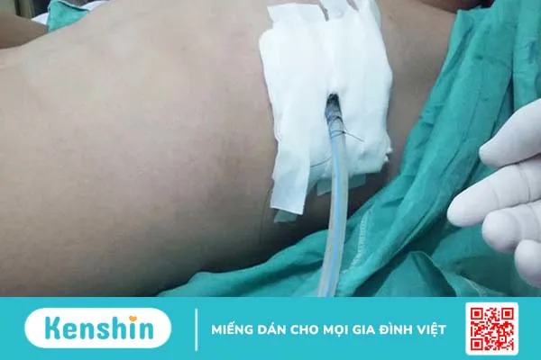 Dẫn lưu bể thận qua da là gì? Hướng dẫn cách chăm sóc người bệnh