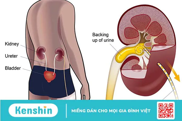 Dẫn lưu bể thận qua da là phương pháp gì?