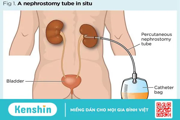 Dẫn lưu bể thận qua da là phương pháp gì?