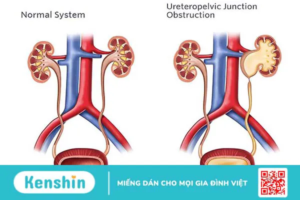 Dẫn lưu bể thận qua da là phương pháp gì?