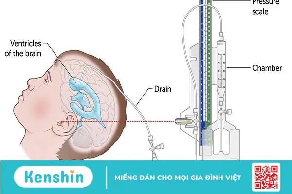 Dẫn lưu não thất được thực hiện khi nào? Quy trình phẫu thuật dẫn lưu não thất