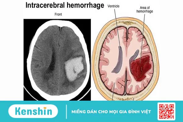 Dẫn lưu não thất được thực hiện khi nào? Quy trình phẫu thuật dẫn lưu não thất