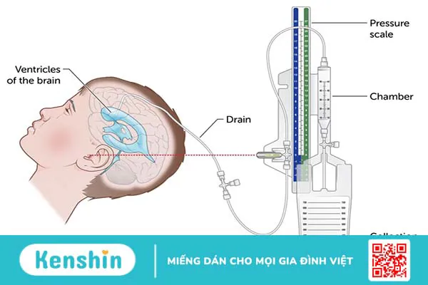 Dẫn lưu não thất được thực hiện khi nào? Quy trình phẫu thuật dẫn lưu não thất