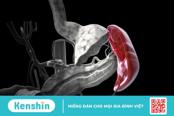 Dập lá lách cấp độ 3: Nguyên nhân, cách điều trị và thời gian phục hồi