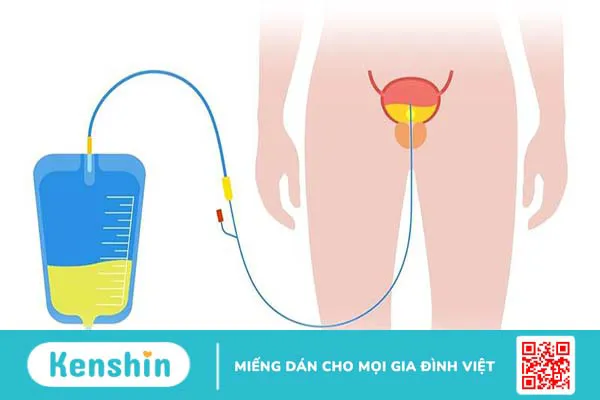 Đặt ống thông tiểu có làm rách màng trinh không?