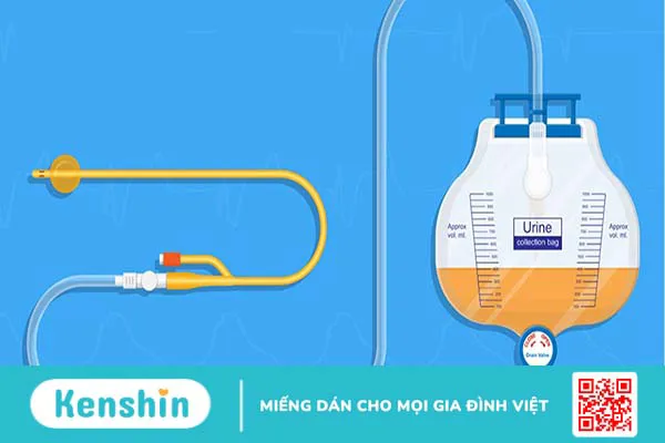 Đặt ống thông tiểu khi mổ đẻ tại sao lại cần thiết?