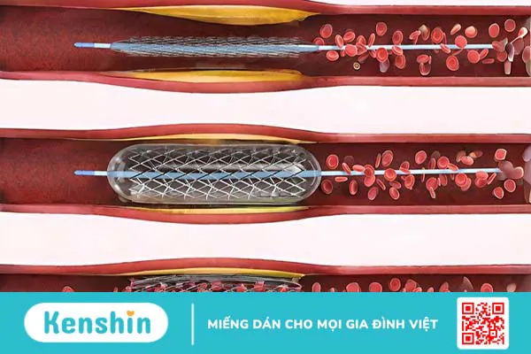 Đặt stent phủ thuốc có an toàn không?