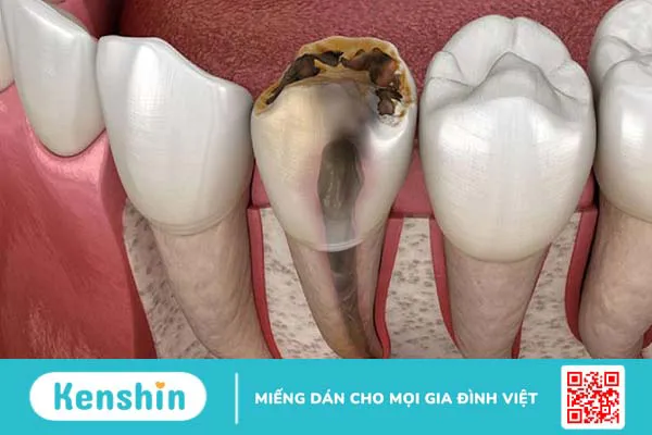 Đặt thuốc diệt tủy răng có đau không? 1