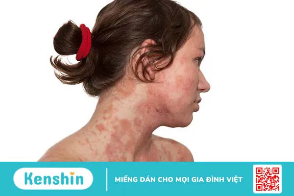 Dầu cá có lợi ích cho bệnh chàm như thế nào 1