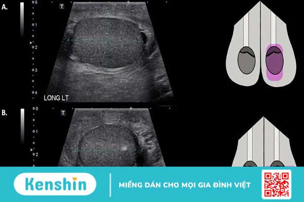 Dấu hiệu chấn thương tinh hoàn và cách xử lý